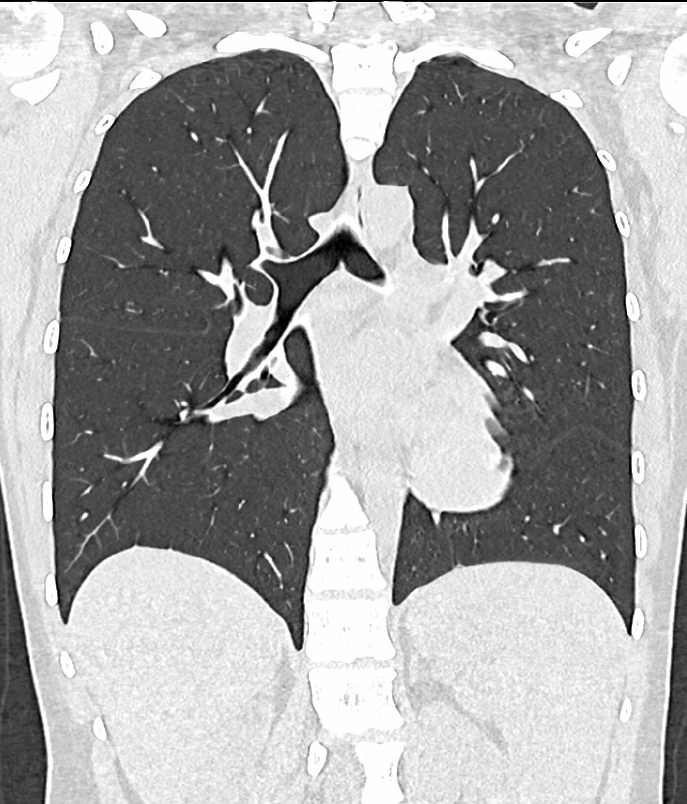 scanner Paris 17 18 scanner thoracique pulmonaire