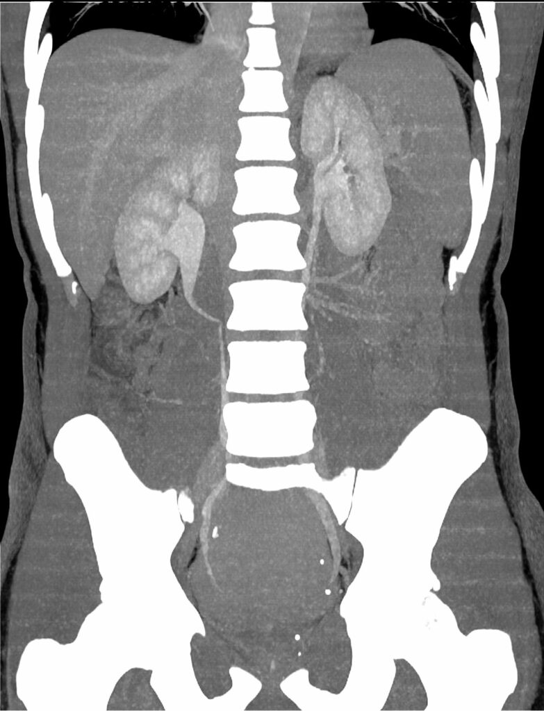 scanner Paris 17 18 uroscanner calcul